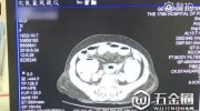 吃楊梅核能清腸道促消化？85歲老太吃1斤楊梅不吐核患腸梗