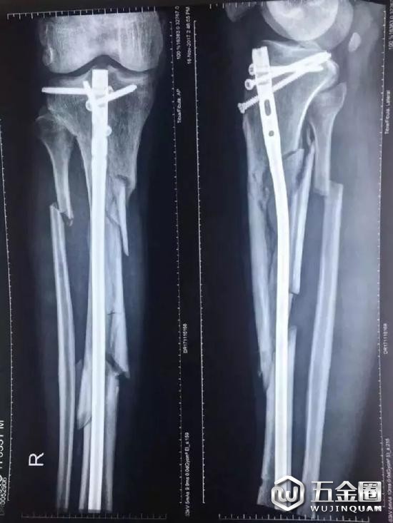 ▲張毅的右小腿骨粉碎性骨折。 圖片來源：新京報